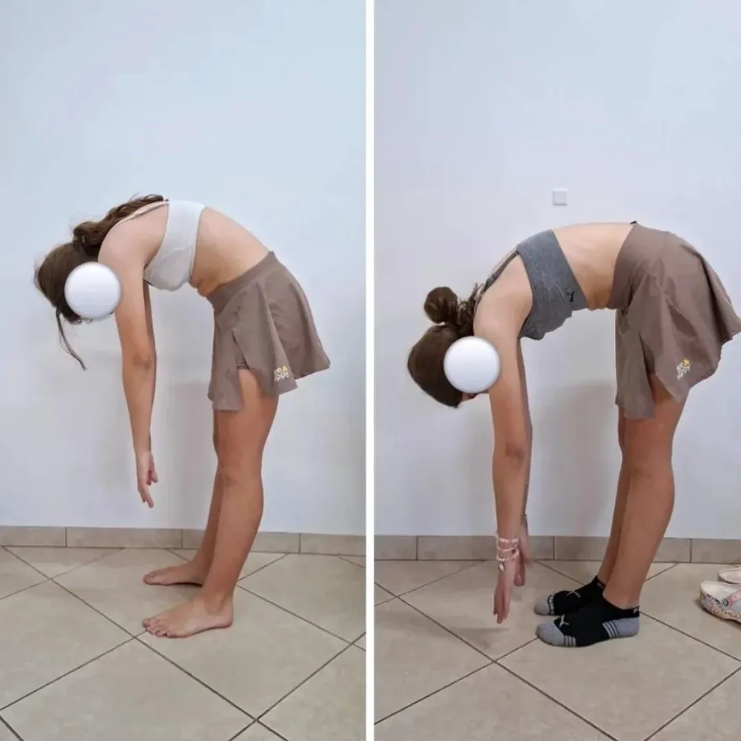 Duas fotos de uma jovem em flexão de tronco, lado a lado, com o rosto coberto, mostrando a evolução na flexibilidade da cadeia posterior