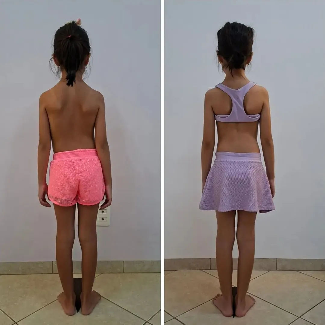 Duas fotos de uma menina de costas, lado a lado, em um caso de escoliose idiopática de início precoce